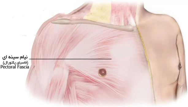نیام-سینه ای-پکتورال-فاشیا